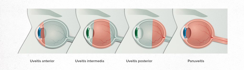 imagenes de retina con  UVEITIS