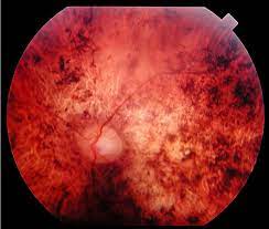 imagen de retina con DISTROFIAS DE CONOS