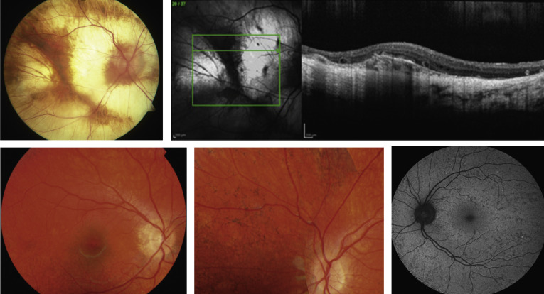 imagenes de retina con CHOROIDEREMIA 