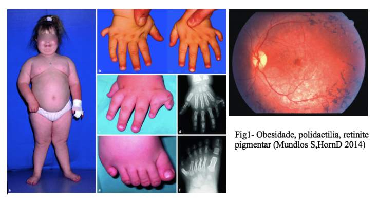 SINDROME DE BARDET- BIEDL imagen de cuerpo, pies, manos, retina con este sindrome 